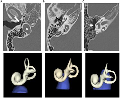 The association between high jugular bulb and mastoid pneumatization in adults